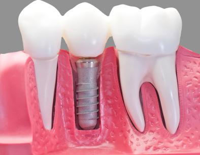 AI? PHÙ HỢP ĐỂ THỰC HIỆN GHÉP RĂNG IMPLANT 