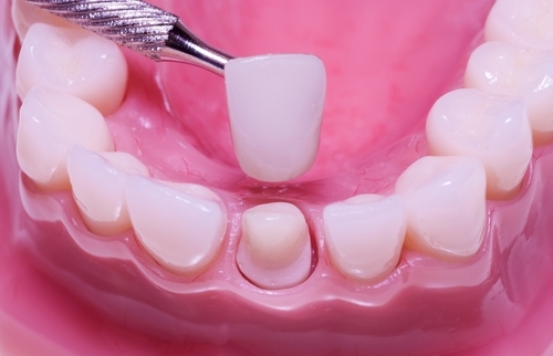 Phương pháp bọc mão (cầu) răng sứ cố định