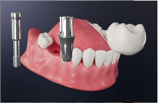 Master Fix - Phục hình bắt vít không chất gắn.